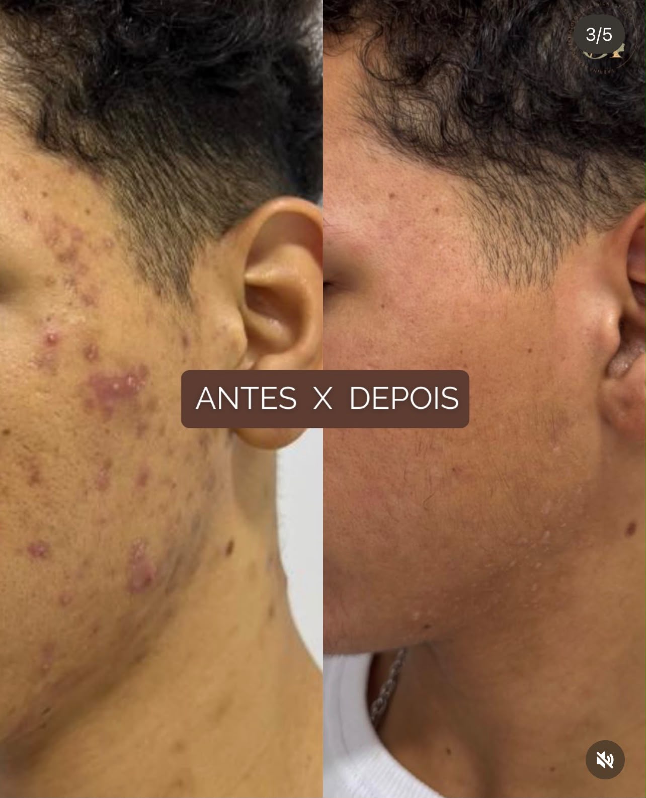 Tratamento de acne na face