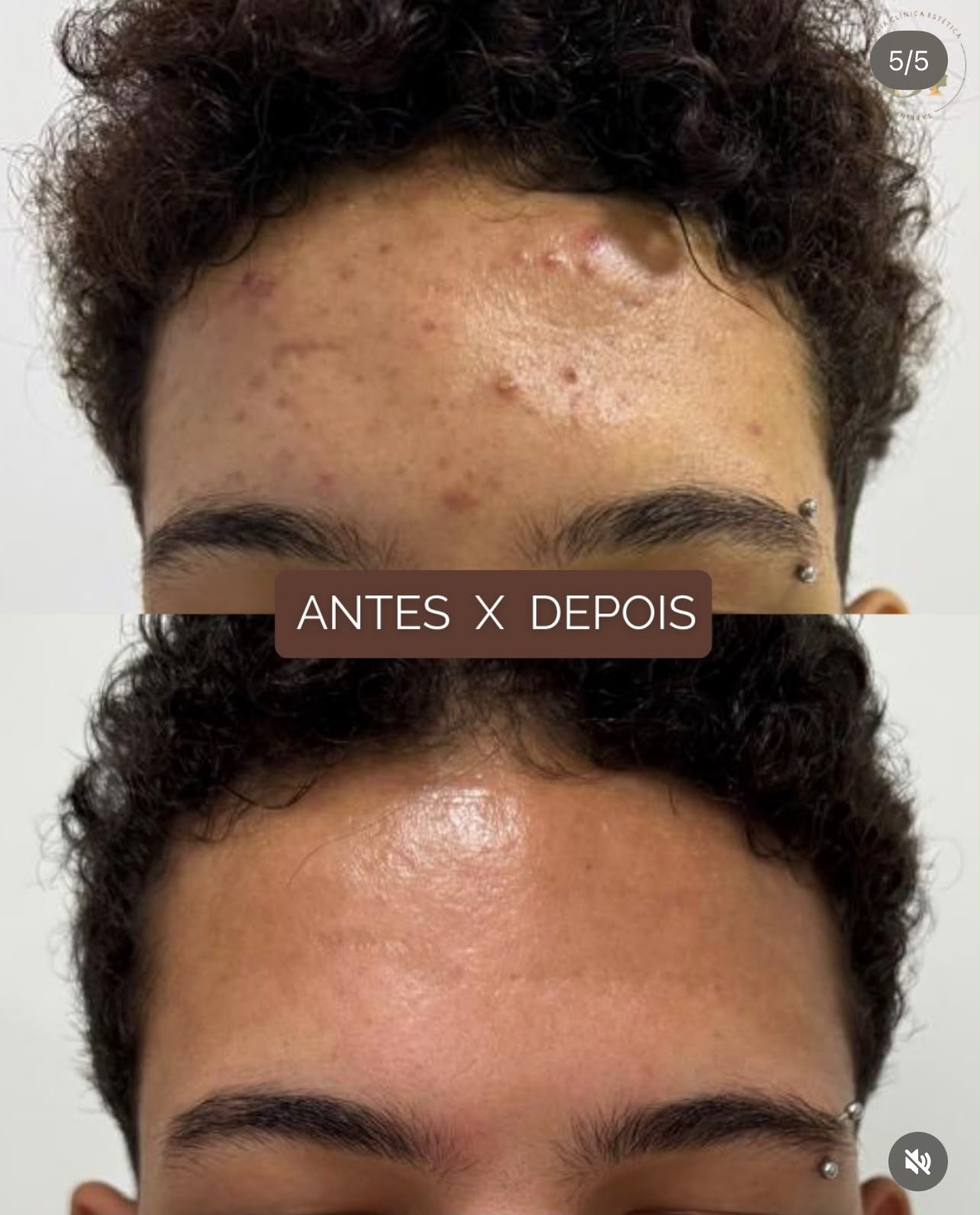 Tratamento de acne na região frontal — antes e depois